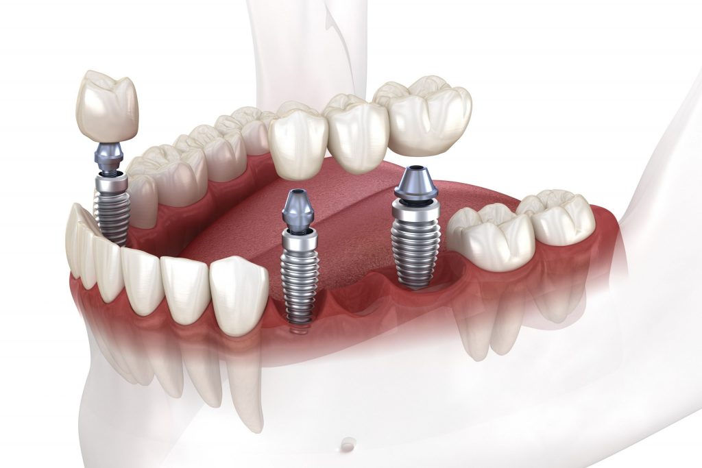 implantes dentarios - osorio saude